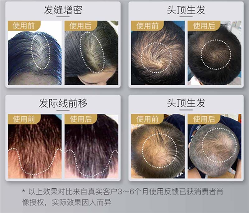 Xiaomi ra mắt mũ kích
thích mọc tóc cho người bị hói, giá 4.9 triệu đồng