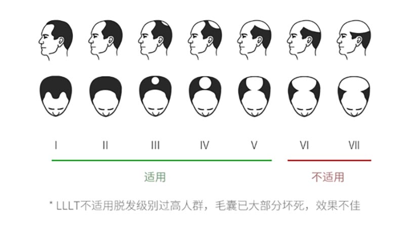 Xiaomi ra mắt mũ kích
thích mọc tóc cho người bị hói, giá 4.9 triệu đồng